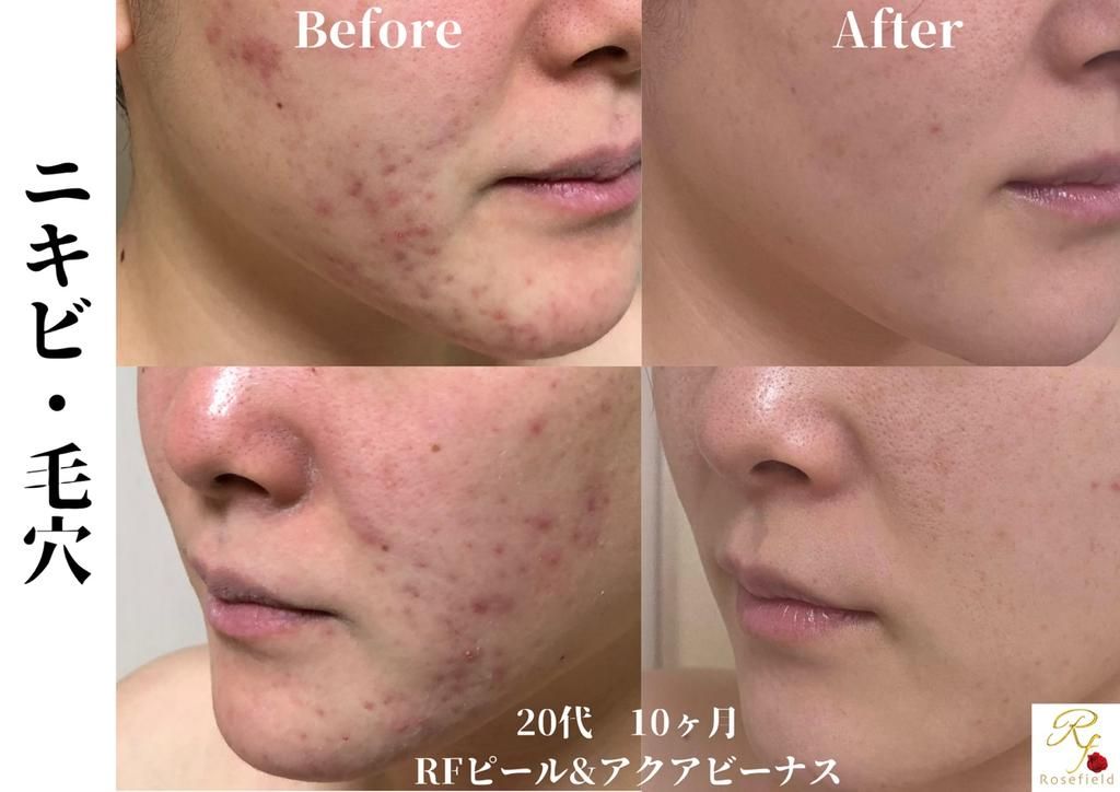 20代 ニキビ・毛穴改善 ビフォーアフター