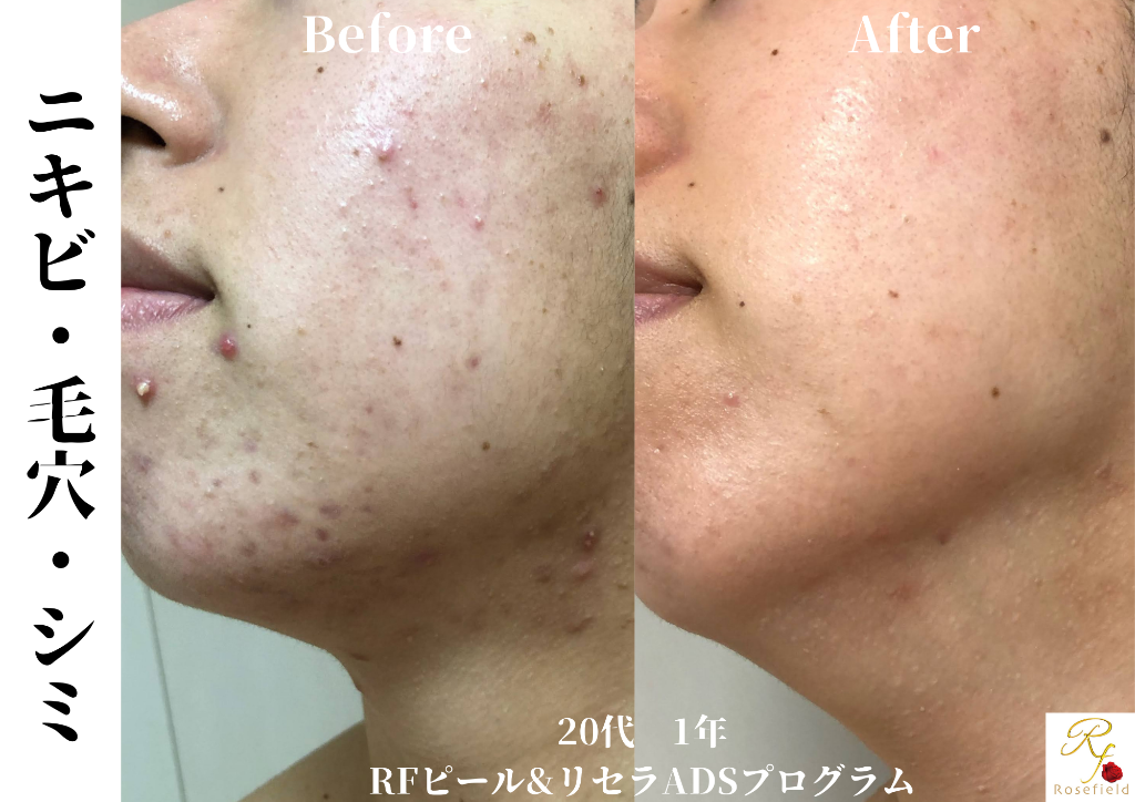 20代ニキビ改善1年