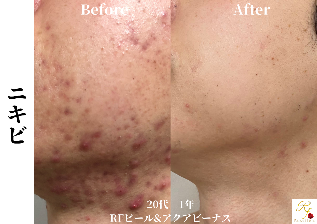 炎症ニキビ改善