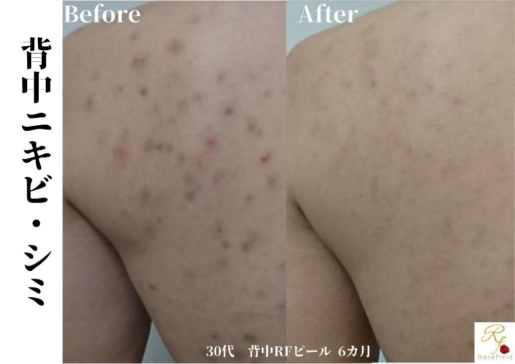 30代背中6ヶ月