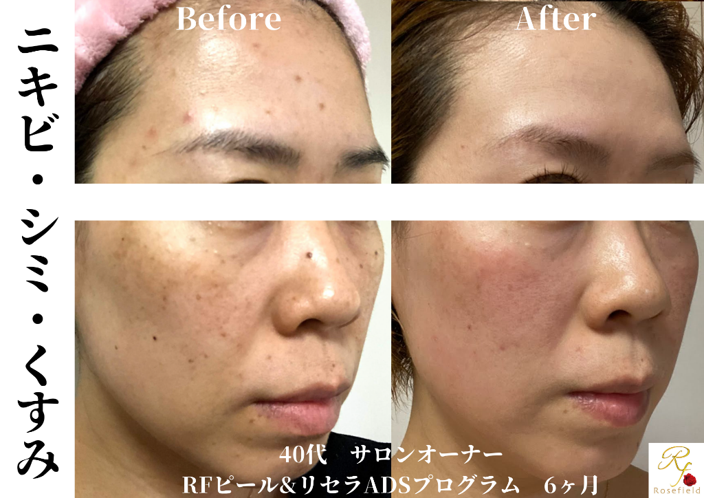 40代シミ改善 斜め